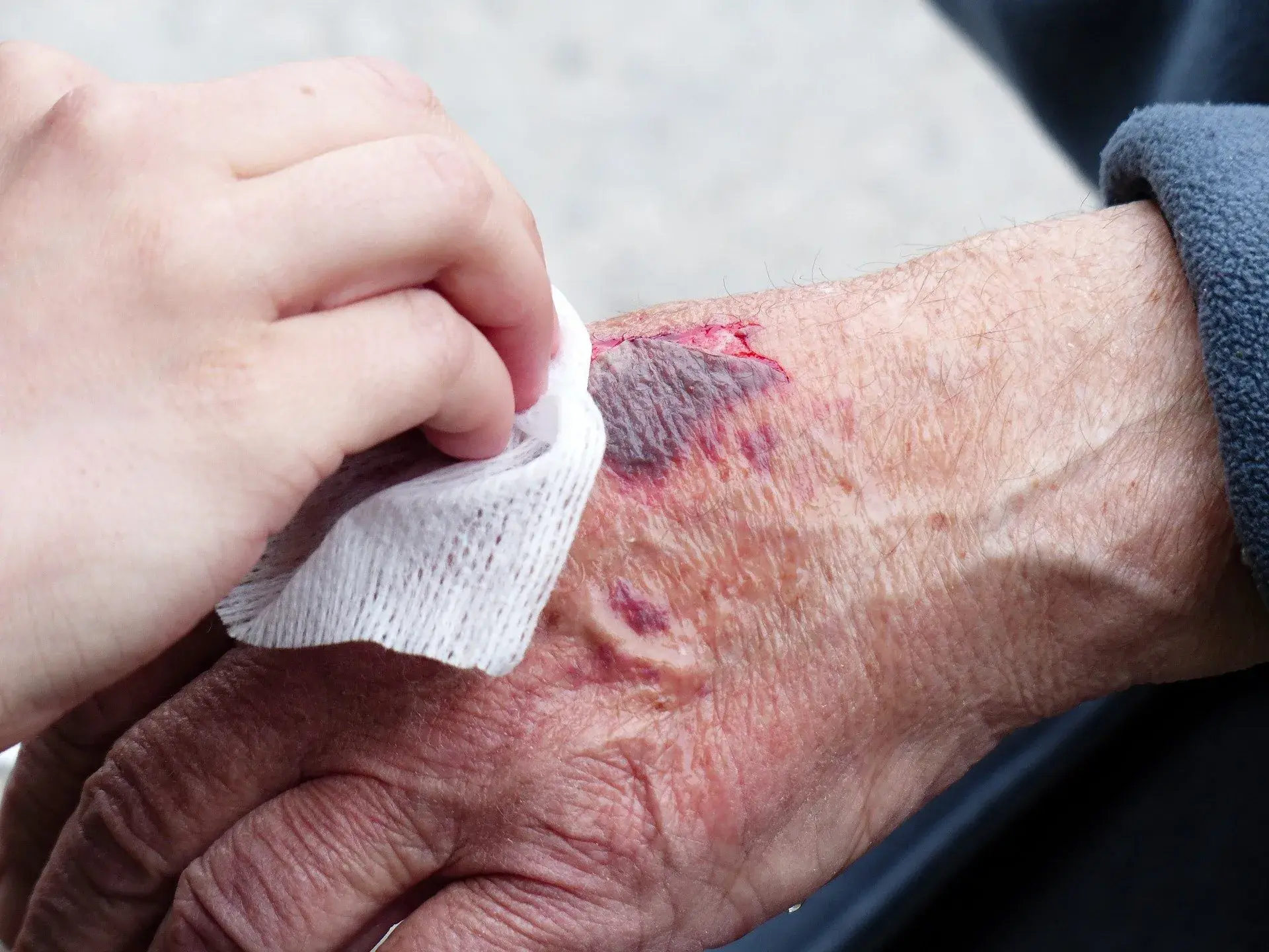 Wound on elderly hand